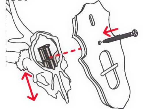 Diagramm, das eine Schädelbasis mit beschrifteten inneren Strukturen, eine Montageplatte mit einer Schraube und rote Pfeile, die Befestigungsrichtungen anzeigen, darstellt.