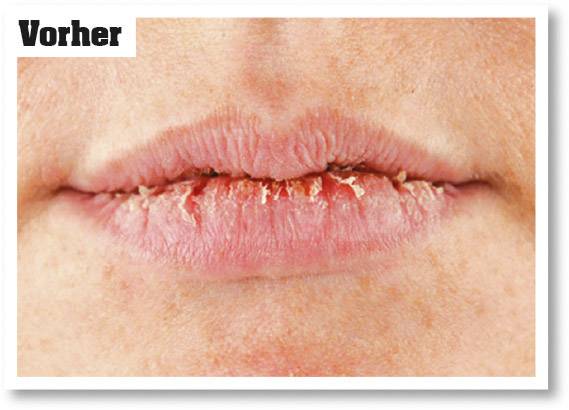 Rissige Lippen mit trockener Haut und Wunden, Nahaufnahme. Text in der oberen linken Ecke: 'Vorher'.
