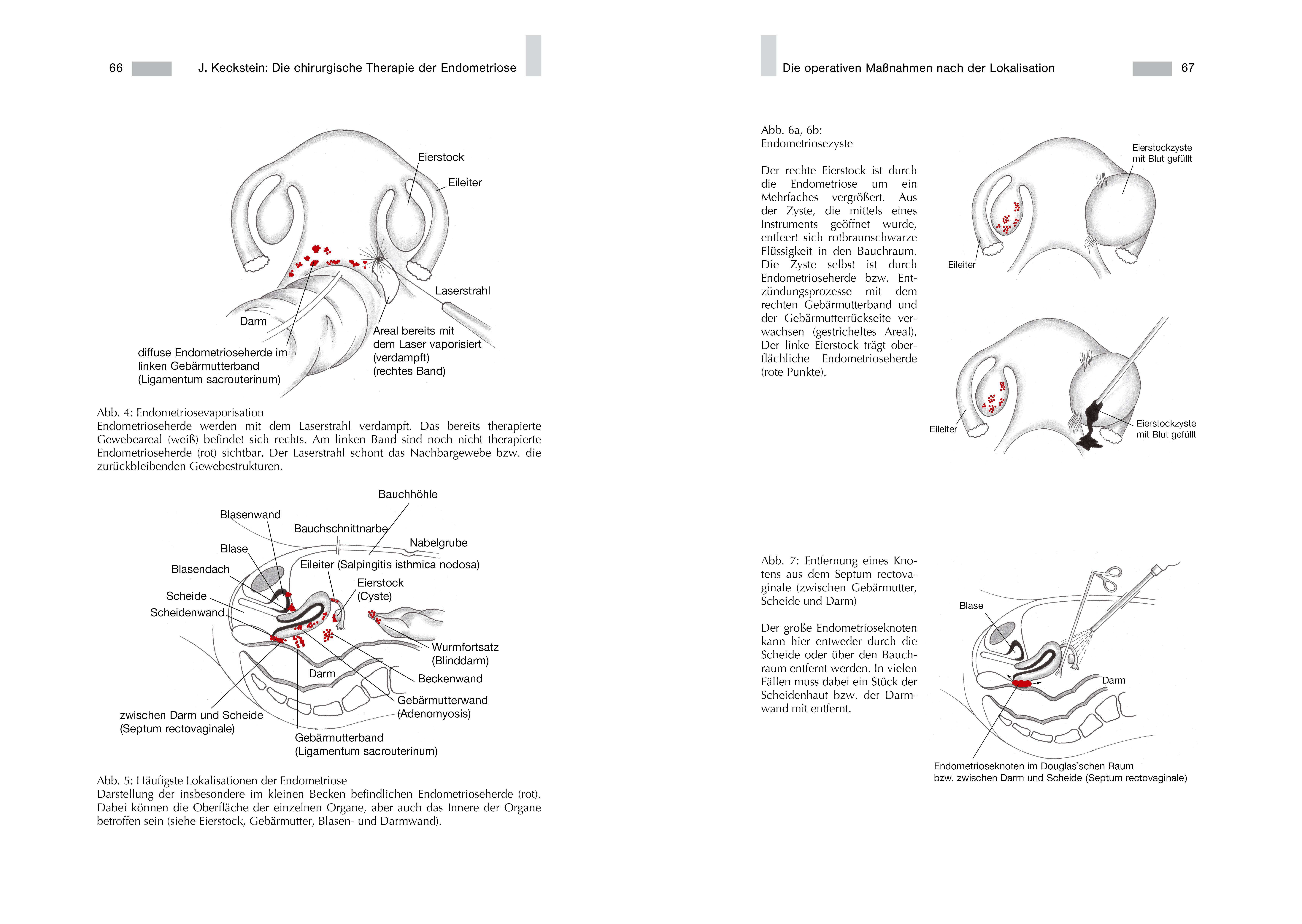 Endometriose - Die verkannte Frauenkrankheit Diagnostik und Therapie aus ganzheitsmedizinischer Sicht