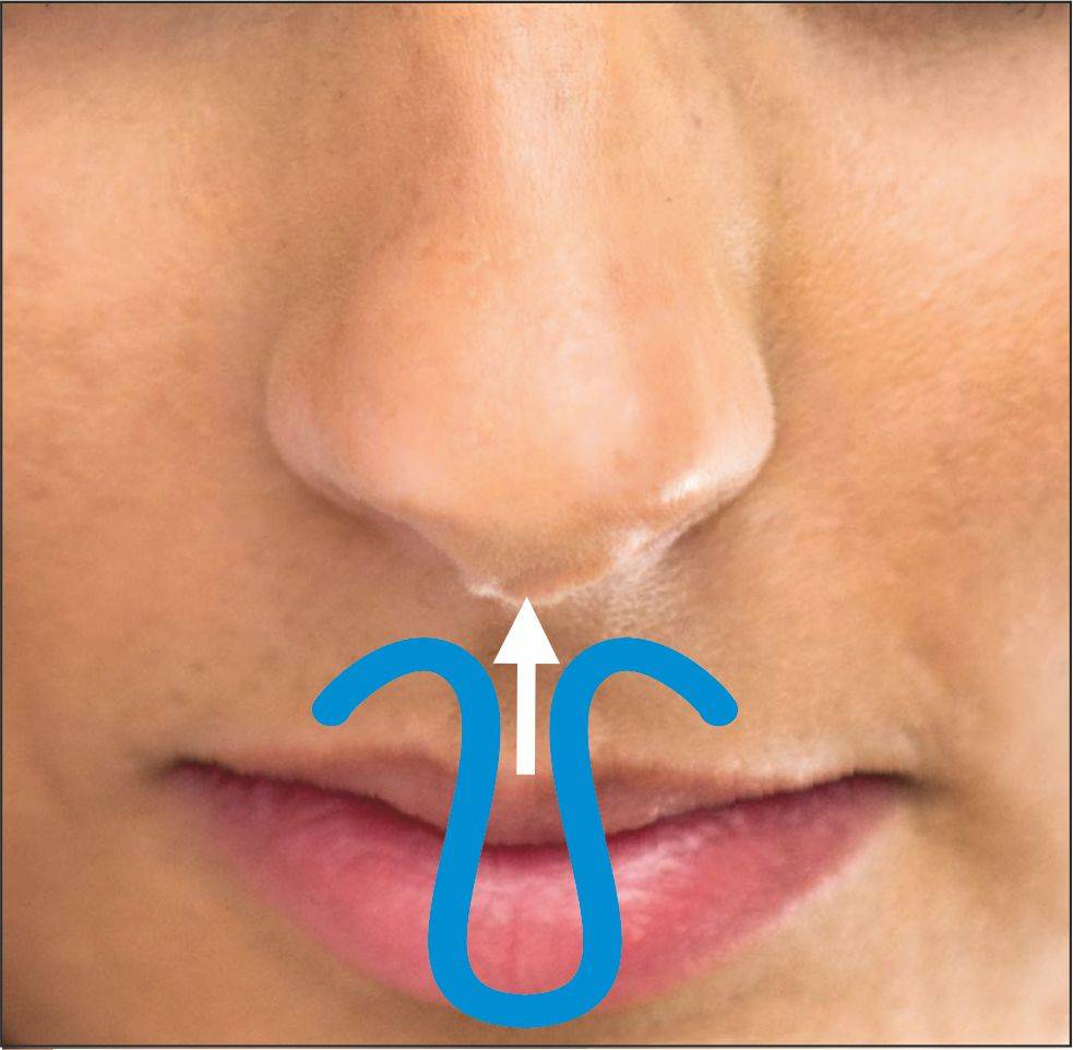 Maximex ClipAir Nasenspreizer gegen Schnarchen