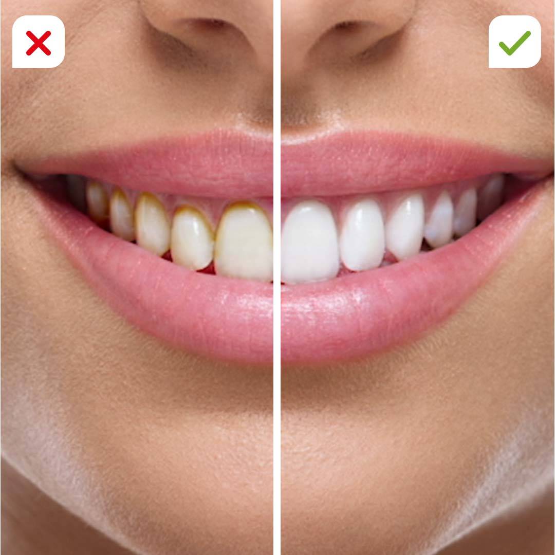 CorpCare Miracle Smile - Reinigungsaufsätze - 2 Stück - Zubehör für CorpCare MiracleSmile Munddusche - 2 Größen