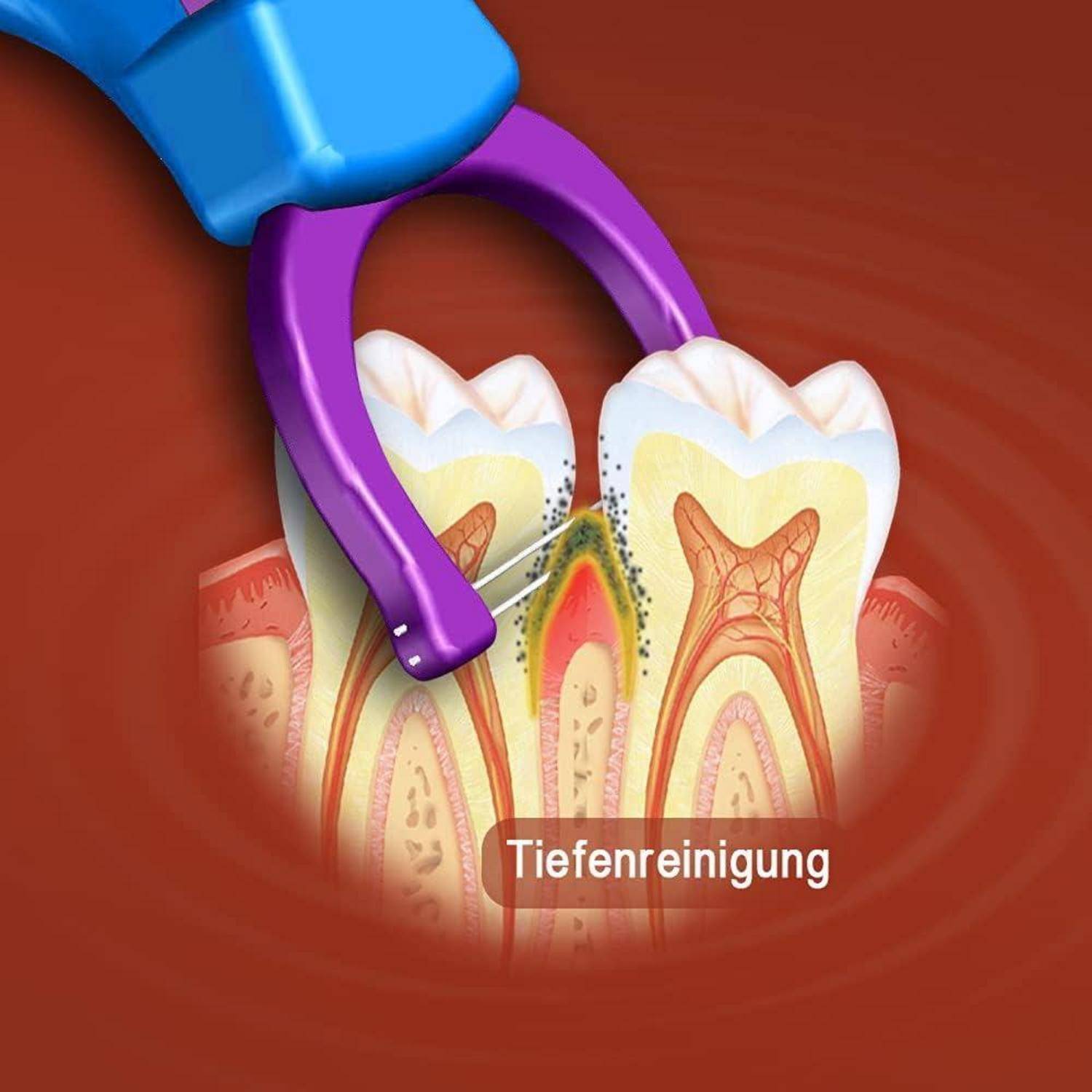 Ein Dentaltool reinigt Plaque und Zahnstein von einer Zahnwurzel, auf einem Querschnittsdiagramm eines Zahnes und Zahnfleisches mit der Bezeichnung 'Tiefenreinigung'.