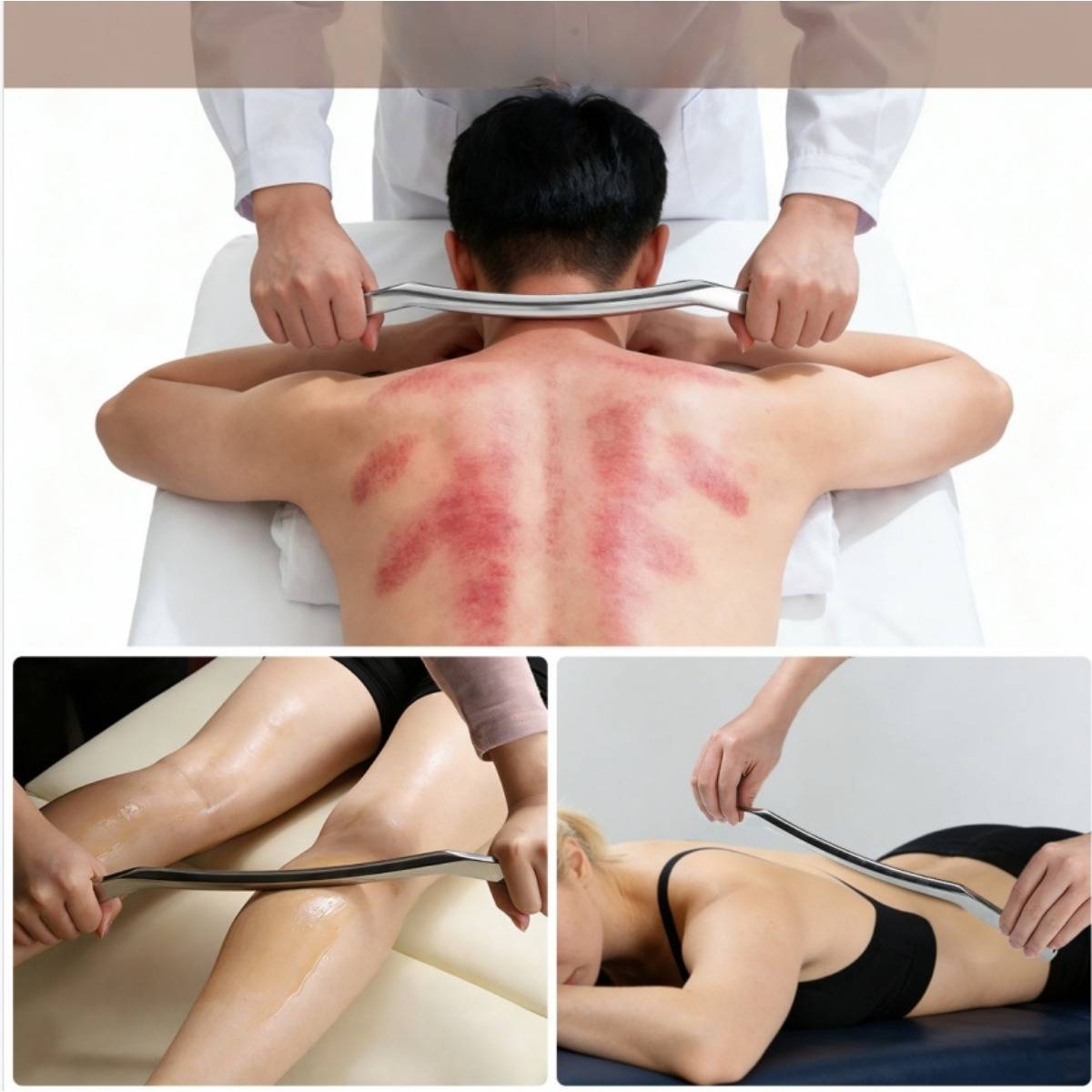 Collage eines Massagetherapeuten, der Gua-Sha-Schabwerkzeuge auf dem Rücken und den Beinen eines Klienten verwendet, mit roten Hautflecken, die von der Behandlung herrühren.
