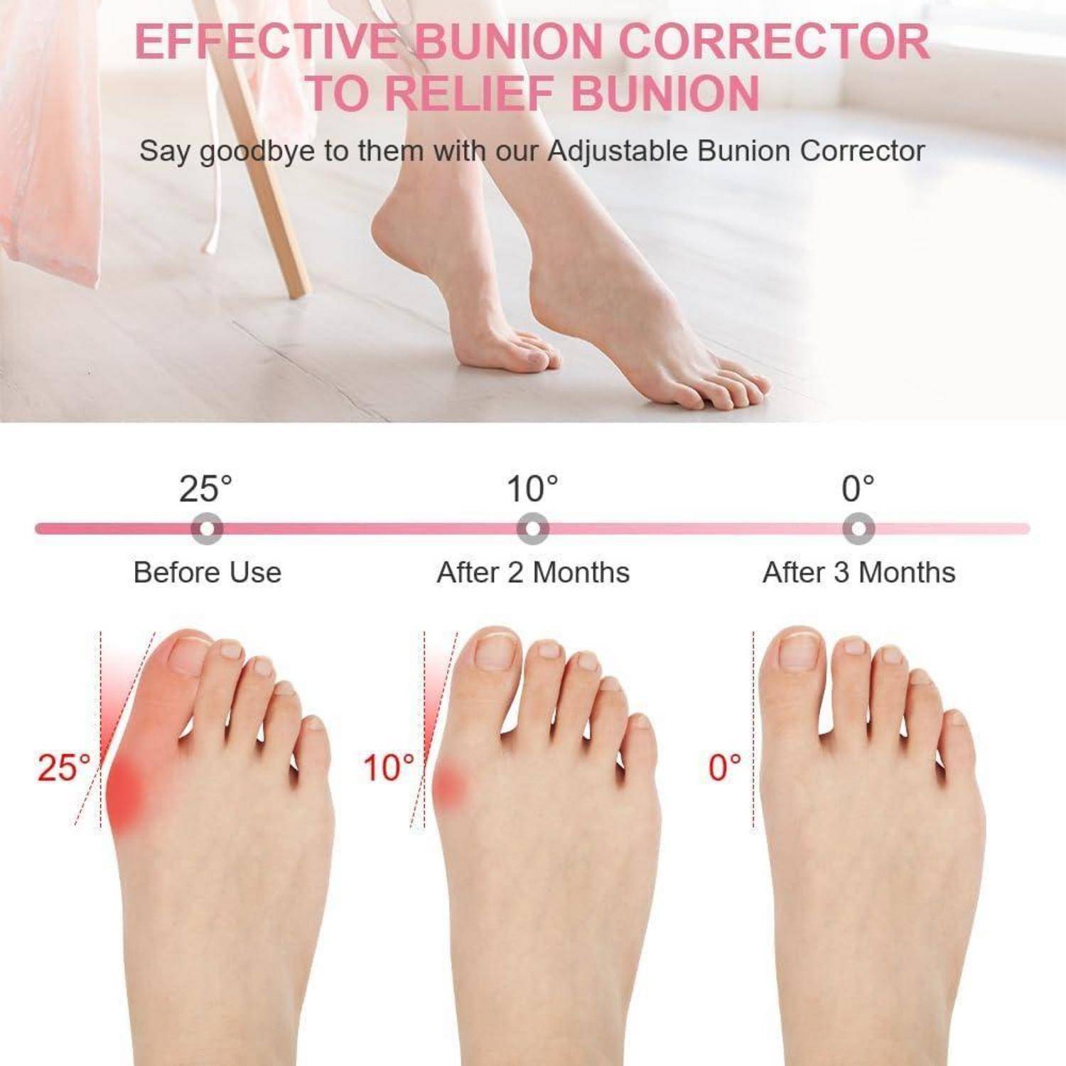 Infografik zeigt einen verstellbaren Hallux-valgus-Korrektor, der den Zehenwinkel von 25° vor der Anwendung auf 10° nach 2 Monaten und 0° nach 3 Monaten reduziert.