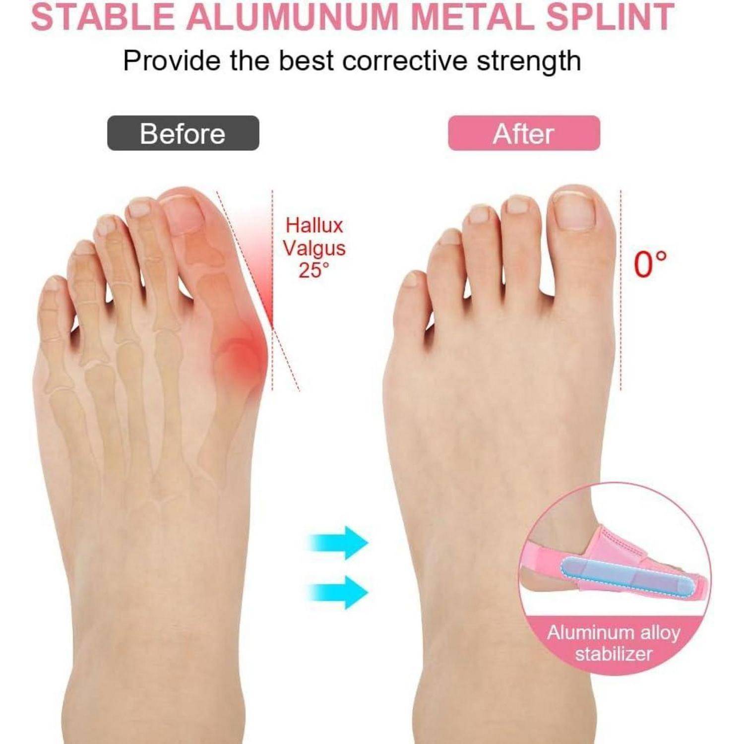 Produktbild, das eine stabile Aluminium-Metallschiene zeigt, die Hallux valgus korrigiert: „Vorher" eine gekrümmte Großzehe bei 25°, „Nachher"" eine gerade Zehe bei 0° mit einem Aluminium-Legierung-Stabilisator.