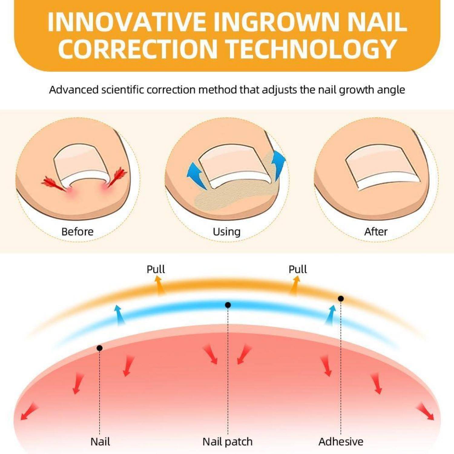 Infografik mit dem Titel „Innovative Technologie zur Behebung von eingewachsenen Nägeln