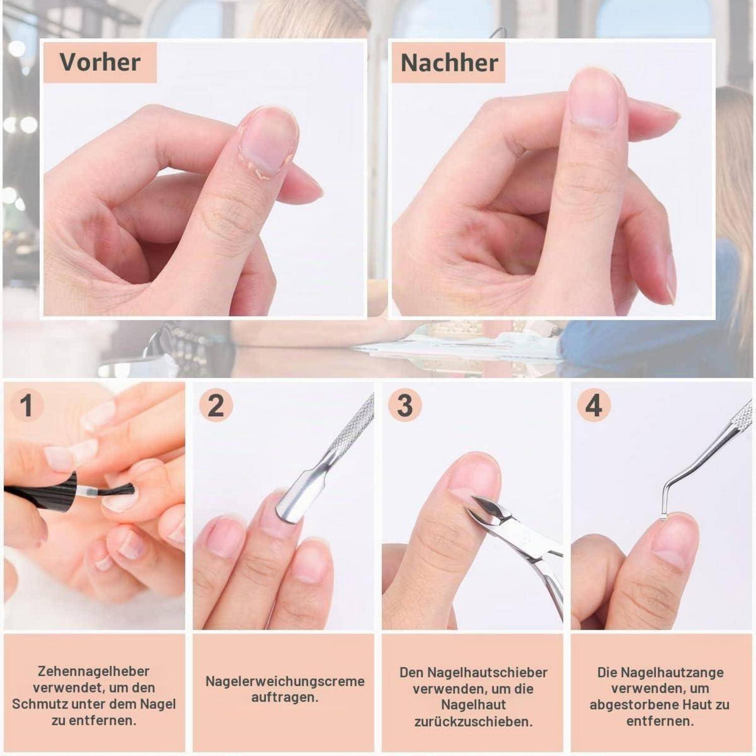 Infografik, die zeigt, wie man einen eingewachsenen Fingernagel behandelt: Vor- und Nachher-Handpositionen und vier Schritte mit Werkzeugen zum Reinigen, Auftragen von Creme, Zurückdrücken der Nagelfalte und Entfernen von toter Haut.