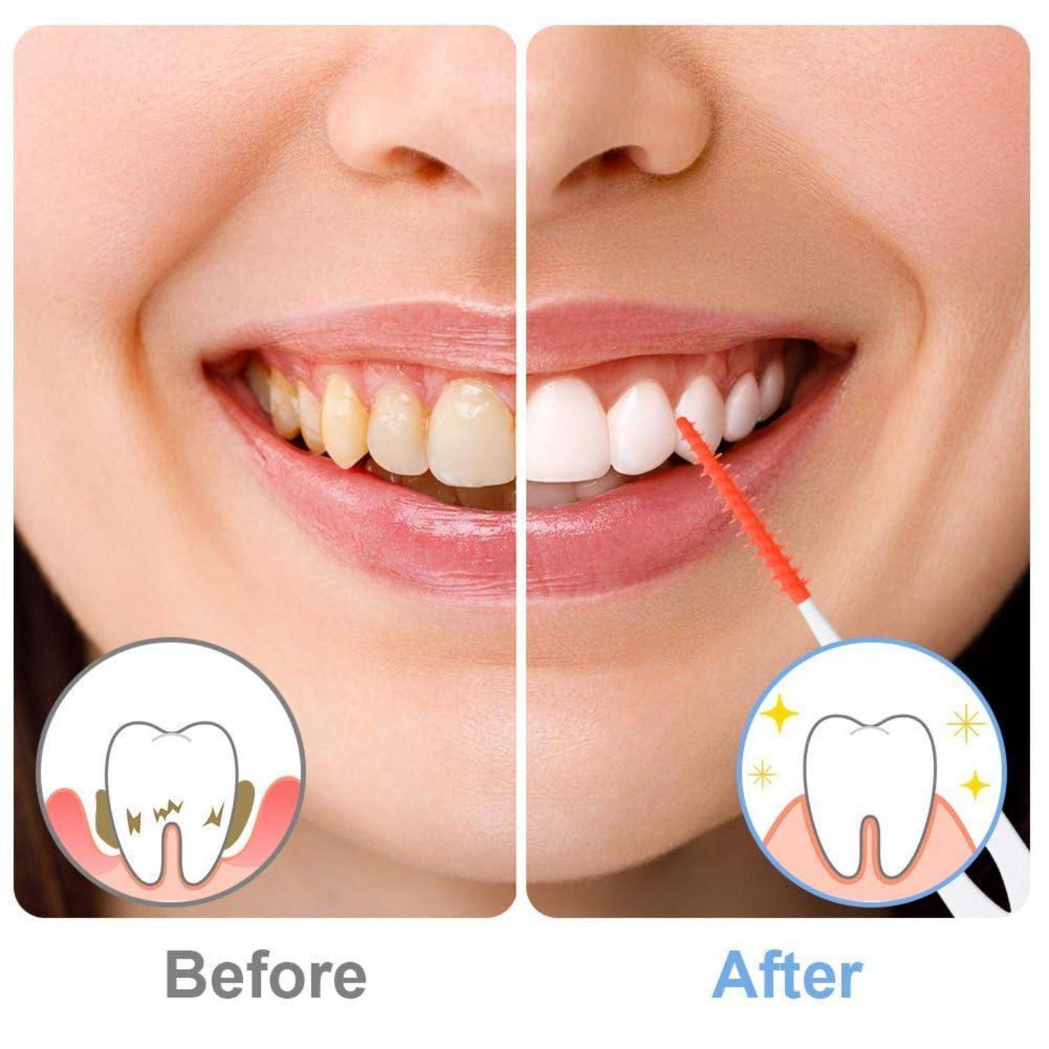Vorher-und-Nachher-Nahaufnahme eines lächelnden Mundes, der verfärbte Zähne zeigt, die sich in weiße Zähne verwandeln, die mit einem Whitening-Applikator gebürstet werden, um eine Zahnaufhellung-Verbesserung zu veranschaulichen.