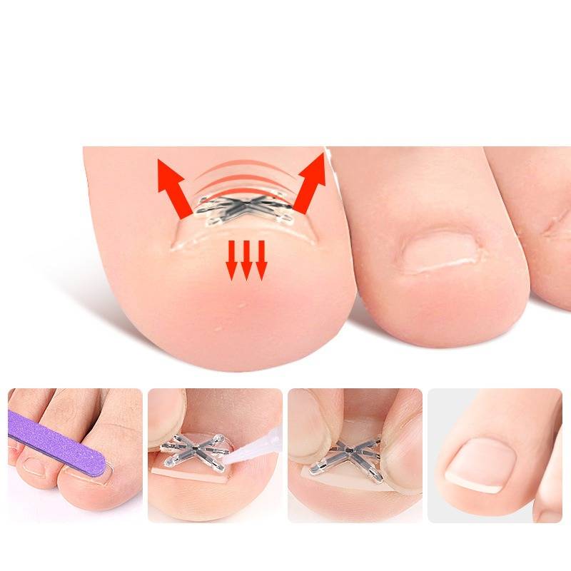 Zehe mit korrigierender Nagelspange, die einen eingewachsenen Zehennagel anhebt; Inlays zeigen die Anwendung und den endgültig gekürzten Nagel.